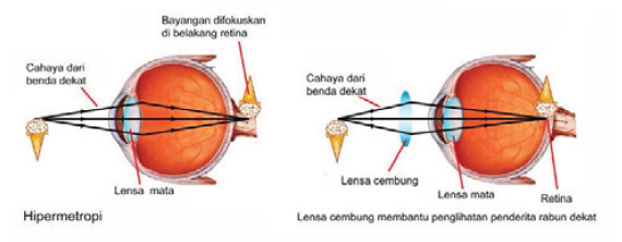 My Blog: Gangguan Pada Indra Penglihatan