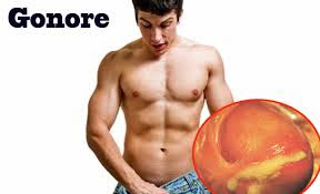 obat gonore obat gonore