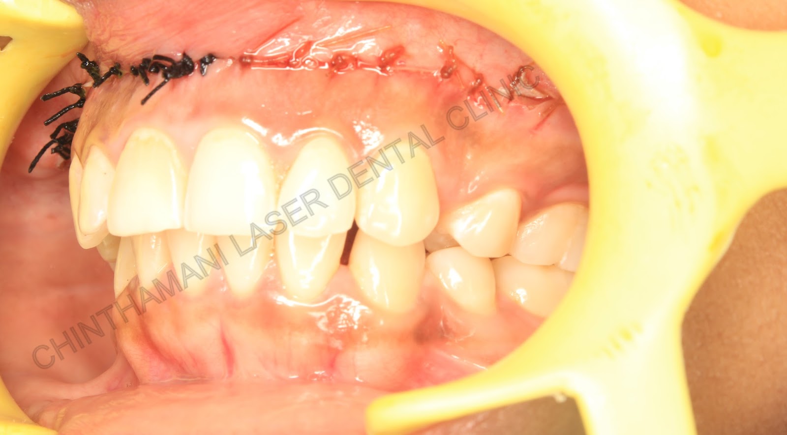 Chinthamani Laser Dental Clinic: LIP REPOSITIONING SURGERY FOR GUMMY ...