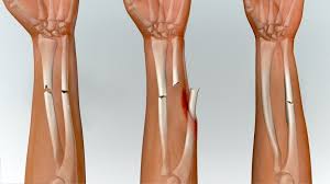 Info Menafaat Inilah Doa Penawarbagi Patah Tulang Atau Retak Apaceritatv