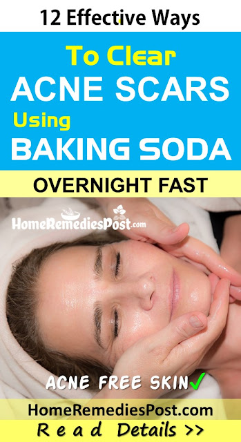 How to Use Baking Soda to Treat Acne Scars and Breakouts Baking Soda For Acne Scars, Baking Soda Acne Scars, Is Baking Soda Good For Acne Scars, How To Use Baking Soda For Acne Scars, Baking Soda And Acne Scars, Does Baking Soda Help Acne Scars