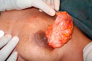 obat kanker payudara ganas obat kanker payudara ganas