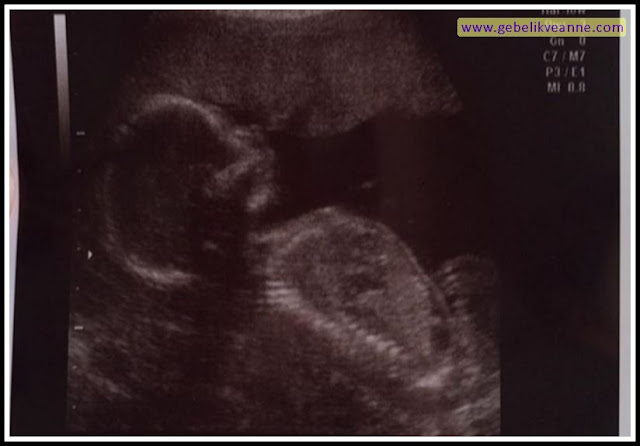 17 Haftalık Gebelik (Hamilelik) Ultrason Görüntüleri