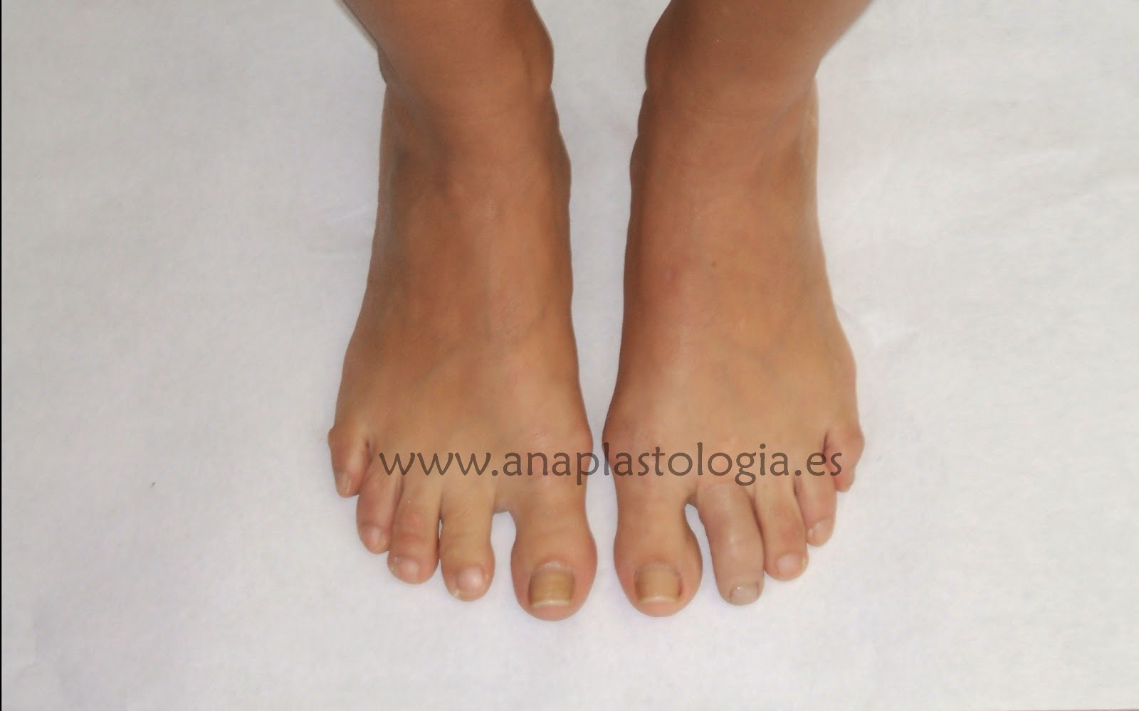  Protesis de pie