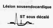 ecg sous décalage infirmier