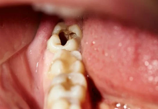 kebiasaan-kebiasaan alami mencegah gigi berlubang
