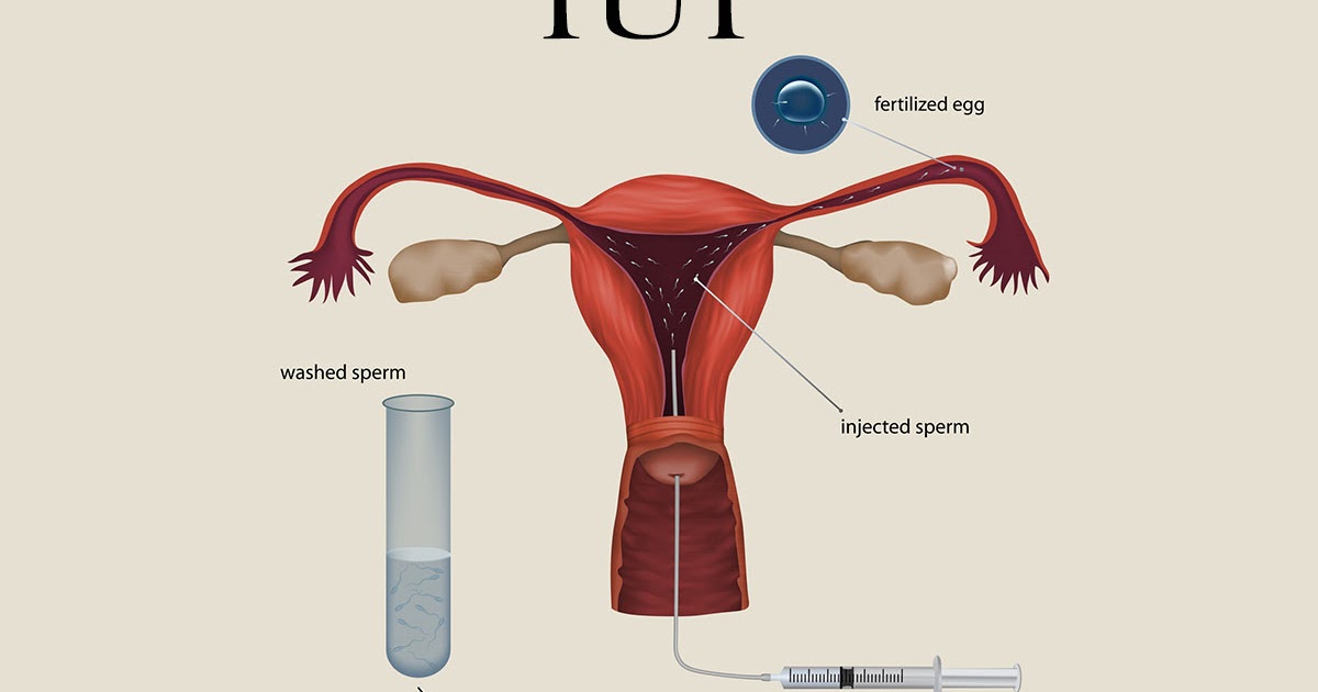 Sperm counts for a successful iui, sexy girls pool