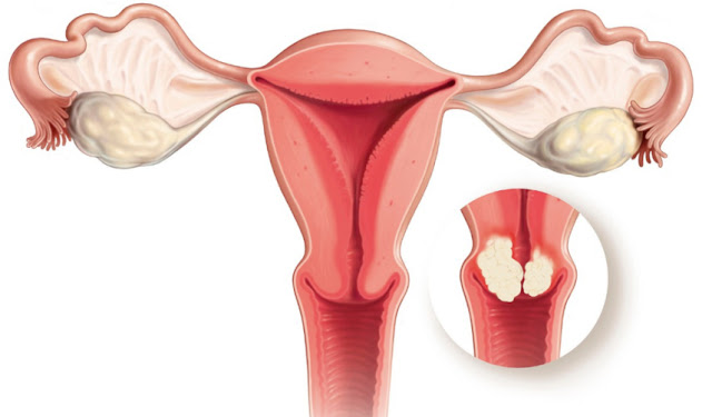 Uterine Cancer Survival Rate Based On Their Stage Of Cancer Uterine Cancer Survival Rate Based On Their Stage Of Cancer