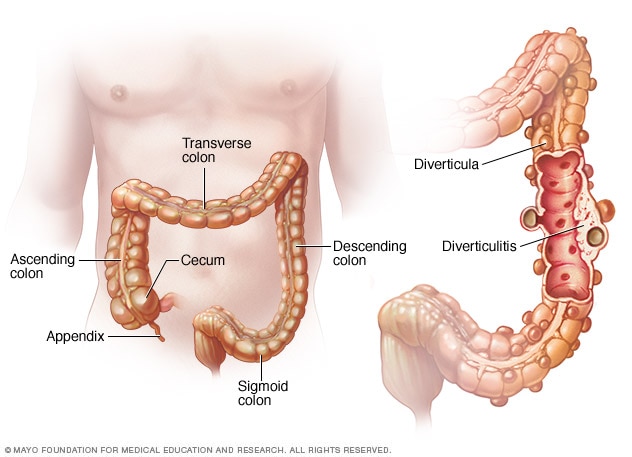 apendicitis da en el lado derecho o izquierdo apendicitis da en el lado derecho o izquierdo