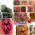 Obat (AmbejOSS) Buat Sakit Wasir di Dubur thumbnail