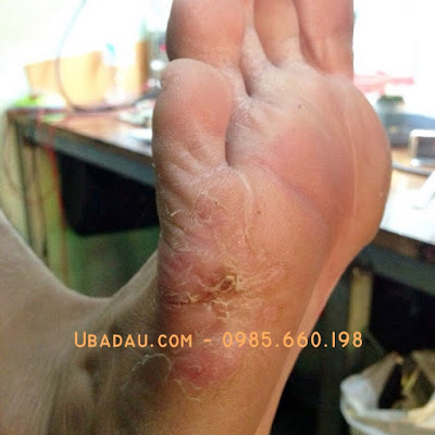 Mổ mắt cá chân bao lâu thì khỏi? Mổ mắt cá chân bao lâu thì khỏi?