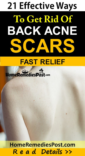 how to get rid of back acne scars, home remedies for back acne scars, clear back acne scars, remove acne scars fast, back acne scars treatment, back acne scars home remedies, how to cure back acne scars, how to cure back acne scars fast, back acne scars remedies, how to treat back acne scars fast, 