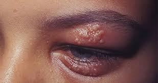 herpes ocular se cura solo