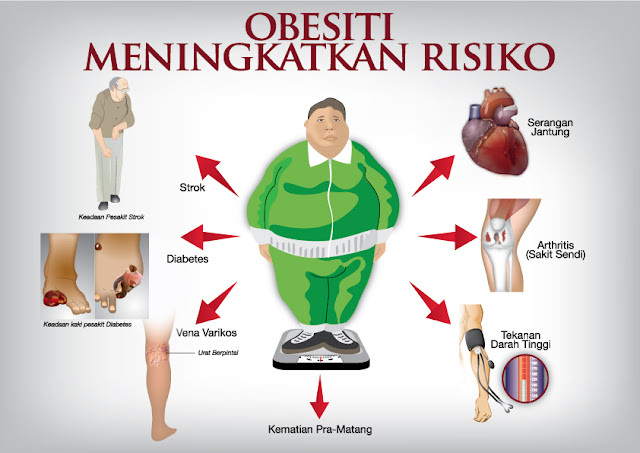 Image result for OBESITI