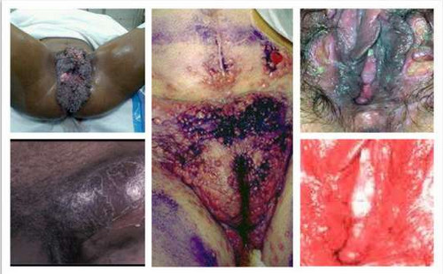 Blue Waffle Disease: Pictures, What is, Causes Blue Waffle Disease: Pictures, What is, Causes
