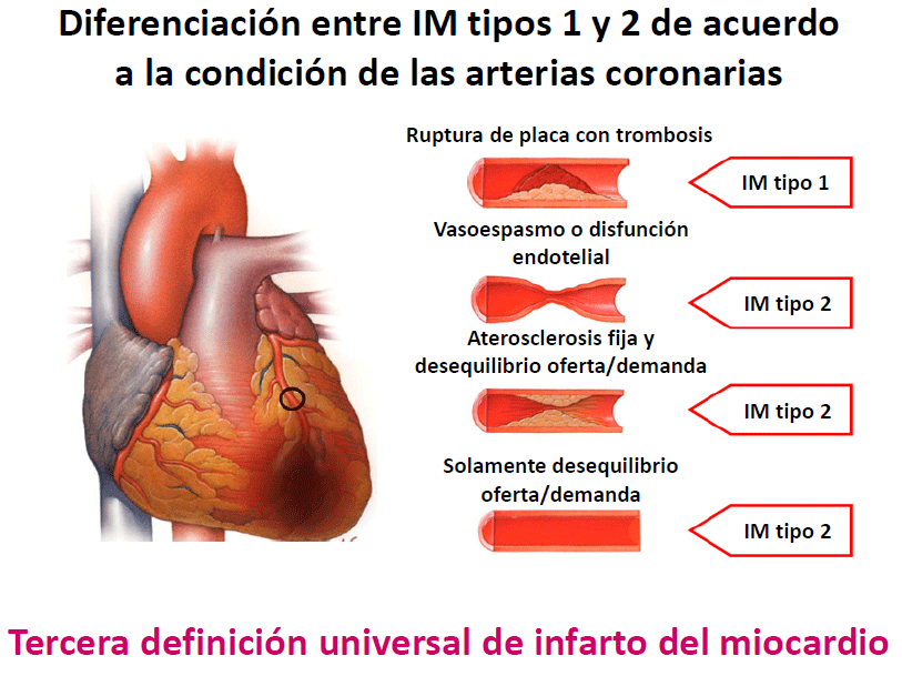 Residentes Medicina Interna HNERM: IMA ST Elevado