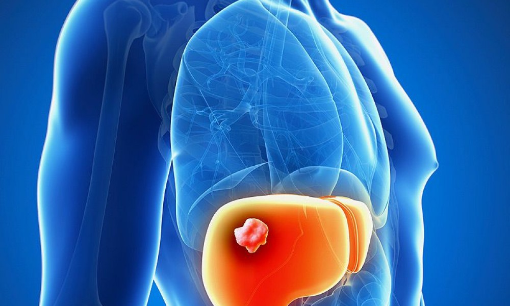 Cancer du foie Symptomes cancer du foie Traitement et cancer du