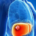 Cancer du foie - Symptomes cancer du foie - Traitement et cancer du foie cause.