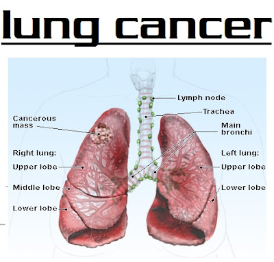 lung cancer treatment | image lung cancer treatment | what ia lung cancer | picture lung cancer treatment | photo lung cancer | what is lung cancer | symptoms lung cancer | lung cancer prognosis | small cell lung cancer | lung cancer survival rate | types of lung cancer | stage lung cancer | 