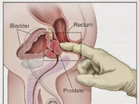 tumor Prostat stadium 1