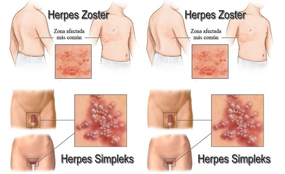 Apotik obat herpes di obat salep