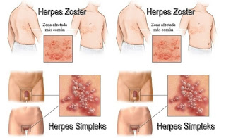 obat herpes genital alami