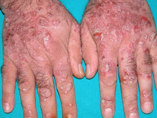 Foto Obat eksim menahun tradisional yang tak kunjung sembuh