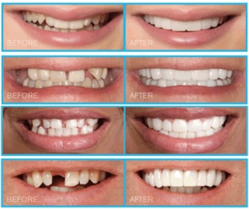 RĂNG SỨ CÓ THAY THẾ RĂNG THẬT ĐƯỢC KHÔNG -5