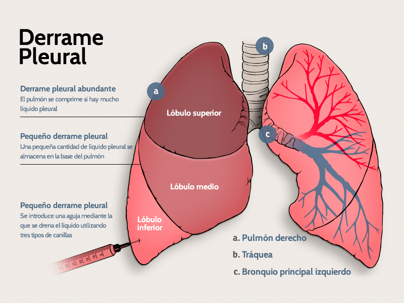 TELEMEDICINA Derrame pleural