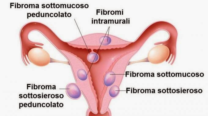 dieta purificante per eliminare i fibromi dieta purificante per eliminare i fibromi