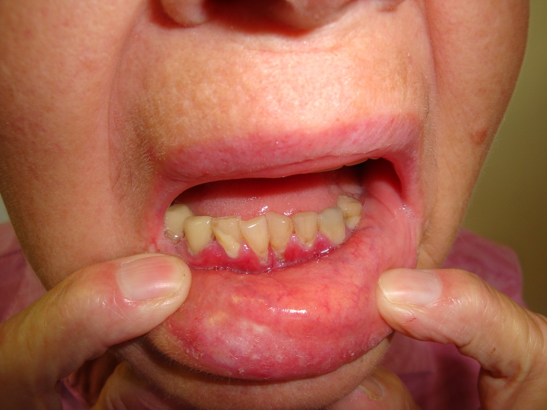 Gum Blister | Painful Gums