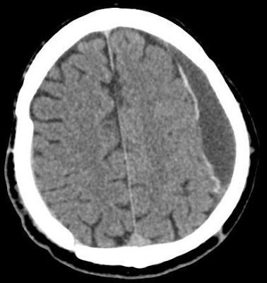 Subacute subdural hematoma with active bleeding