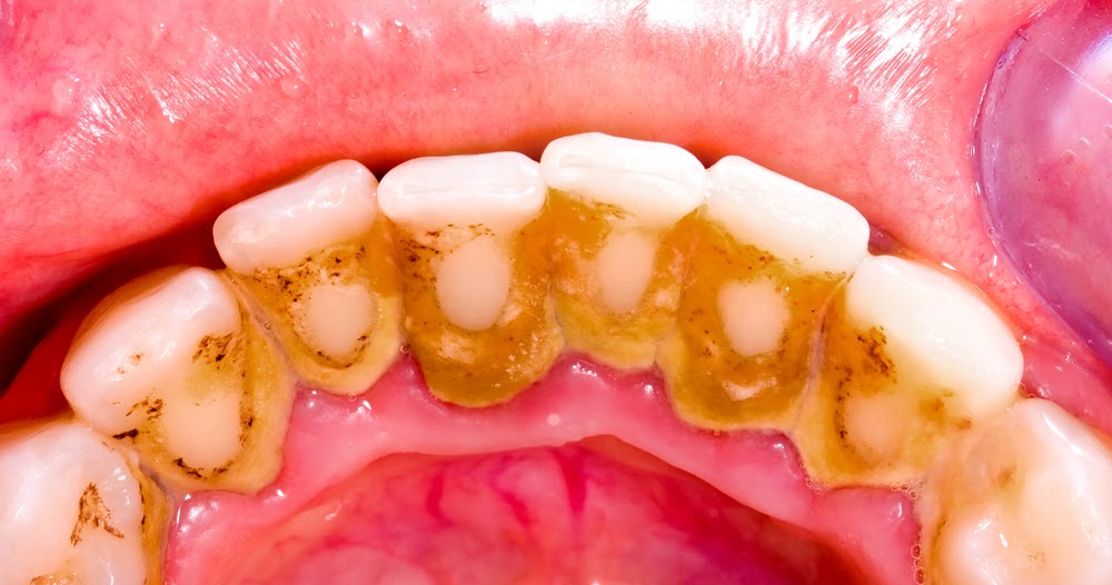 Dental Plaque Causes Symptoms Prevention And Treatment