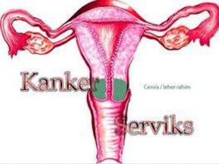 Foto Gejala Gejala Kanker Serviks
