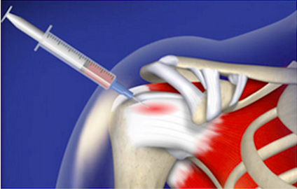 Shoulder Arthritis / Rotator Cuff Tears: causes of Shoulder Arthritis / Rotator Cuff Tears: causes of