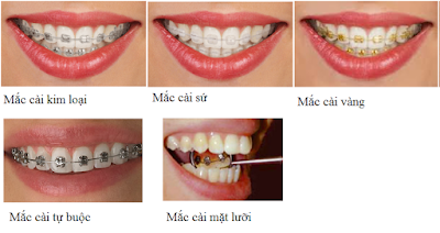 Chi phí niềng răng được quyết định bởi loại mắc cài bạn chọn Chi phí niềng răng được quyết định bởi loại mắc cài bạn chọn