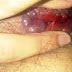 Obat Ambeien Luar Di Apotik thumbnail