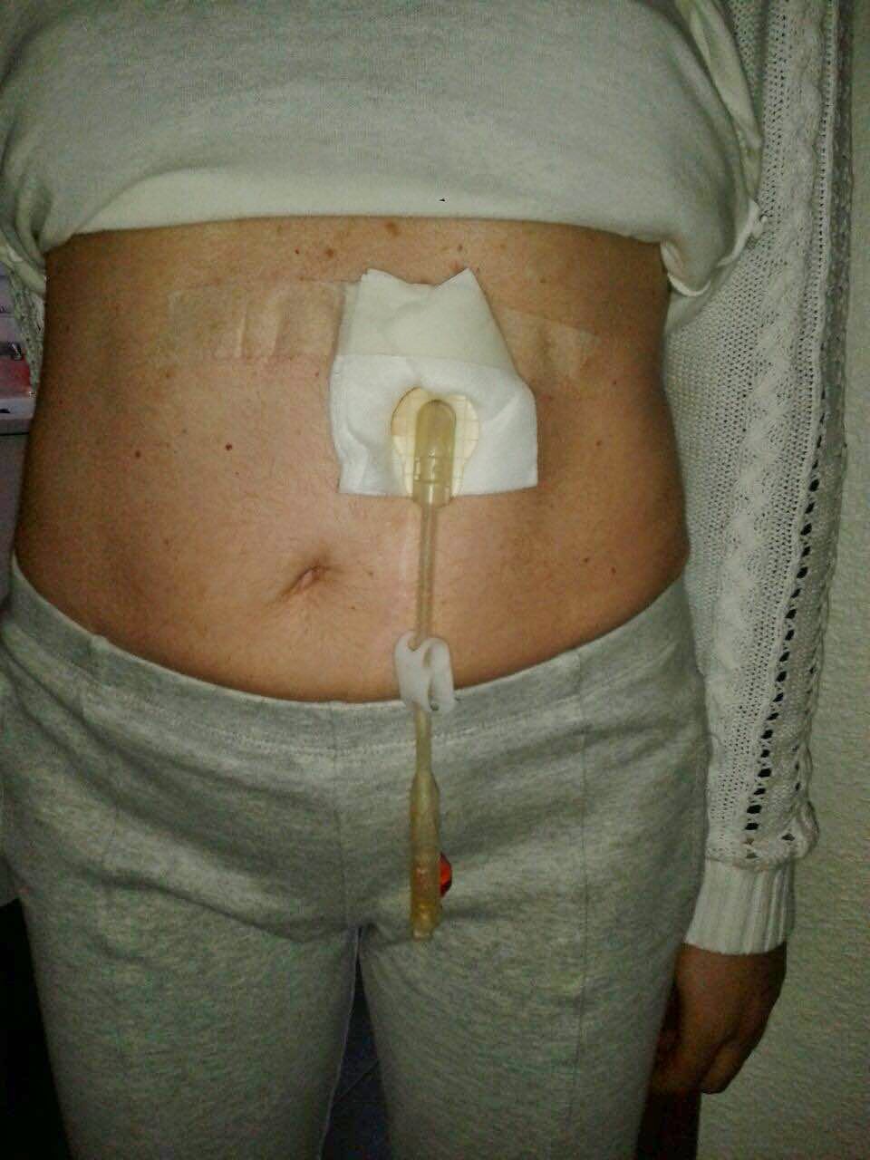 Sonda PEG cinturón