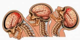 Terapia ocupacional: Lesiones cerebrales por trauma