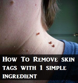 removing skin tags removing skin tags