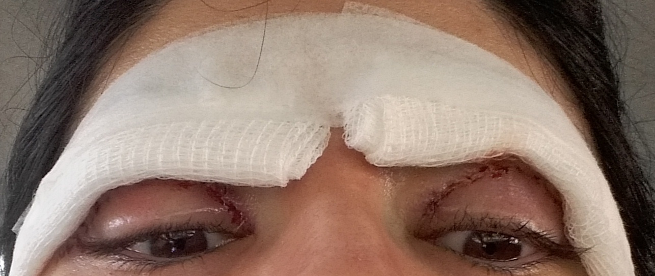 Curativo A Vácuo Antes E Depois Diário de uma emagrecente: Minha cirurgia nas pálpebras