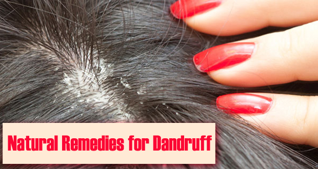 Top 7 Permanent Home Remedies For Dandruff !