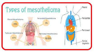 Mesothelioma_Cancer_Treatment