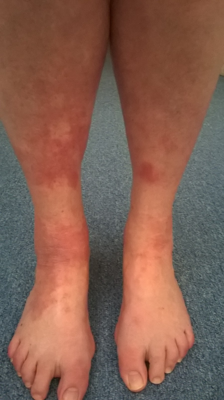 Light Therapy for Eczema Start of a new journey A year on since the