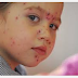 BUSBUSKA WAA MAXAY CHICKEN POX thumbnail