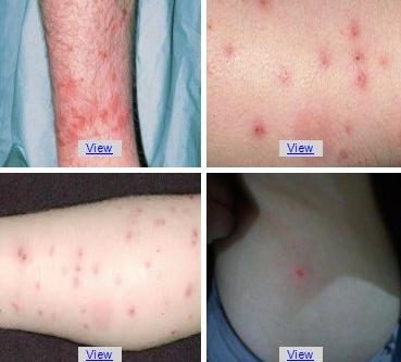 Natural Flea Bite Remedies For Humans Natural Flea Bite Remedies For Humans