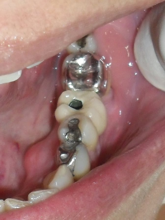 Dr. Elcio O. Libert Dias - Dentista: Implante Dentário