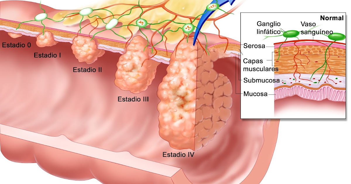 Diario de Prácticas Neoplasia de colon Diario de Prácticas Neoplasia de colon