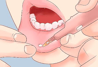 Comment soigner les aphtes et les plaies de la bouche guérir une plaie dans la bouche
