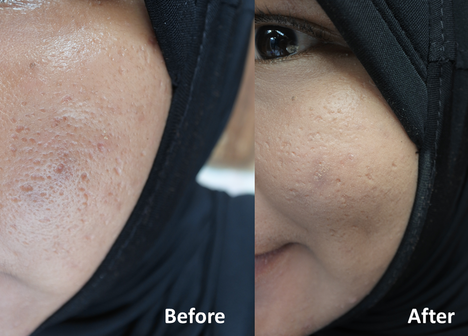 Review Cantik Dari Dalam Dengan H2 Pure Skin Cegah Jerawat Dan Minyak Berlebih Nand S By Anisa Nurrananda